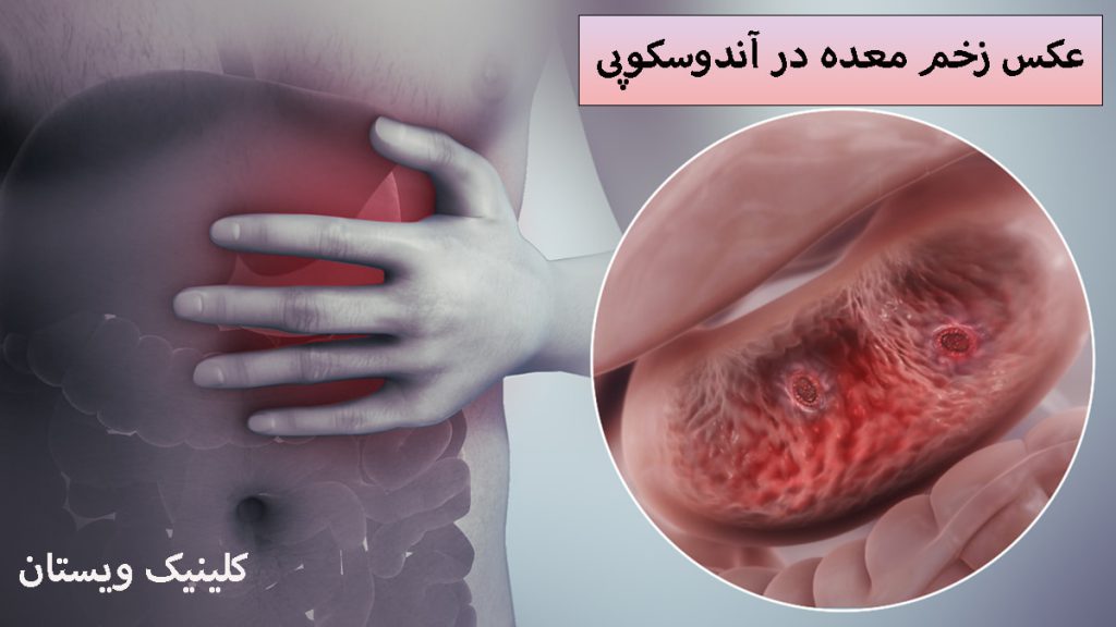 زخم معده بصورت زوم شده 