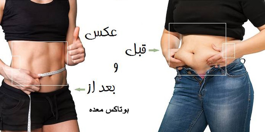 عکس قبل و بعد بوتاکس معده