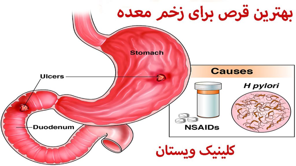 تصویری انیمیشنی از معده و قرص