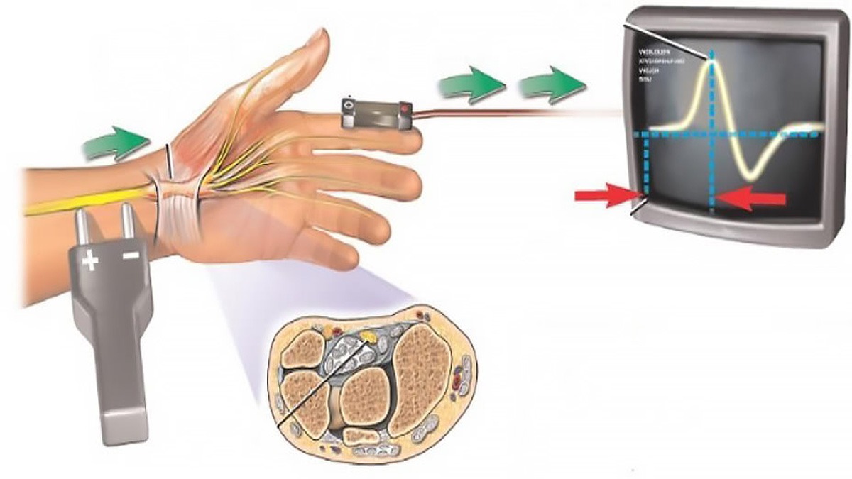 فرایند تست نوار عصب و عضله