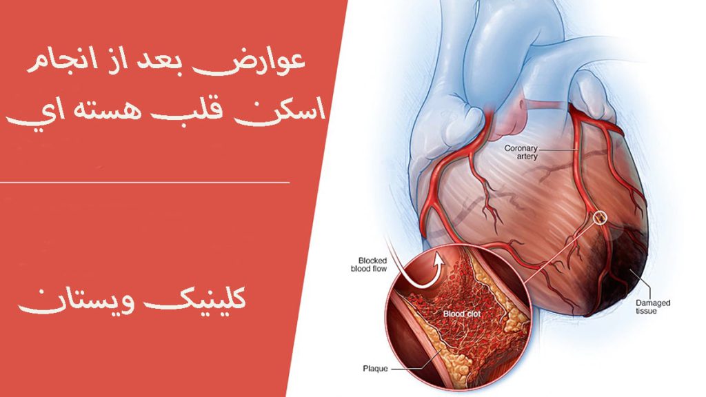 عوارض بعد از اسکن هسته ای یک قلب که گرفتگی رگهای آن نشان داده شده است-نوشته با عنوان عوارض بعد از اسکن هسته ای قلب-عوارض اسکن هسته ای قلب برای اطرافیان