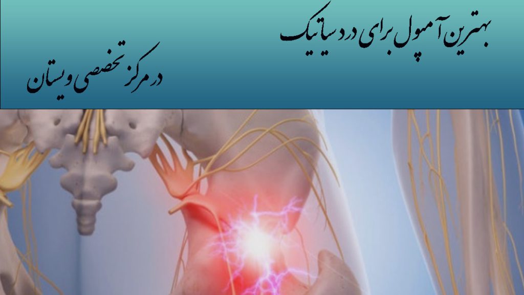 آمپول برای درد سیاتیک درد در قسمت سیاتیک با رنگ قرمز نشان داده می شود-نوشته با عنوان بهترین آمپول برای درد سیاتیک