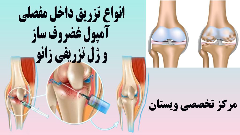 دو تصویر از تزریق ژل به زانو