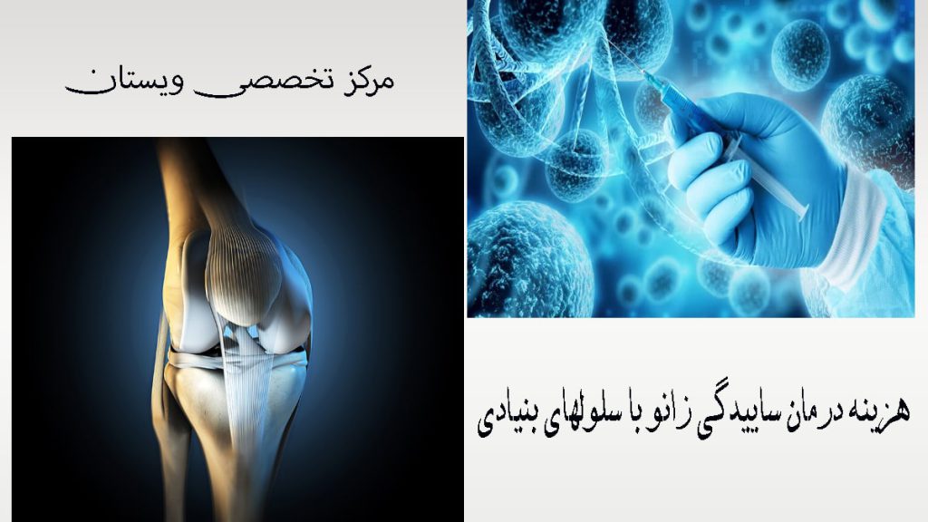 دو تصویر دیجیتالی از از تزریق سلول بنیادی به زانو -نوشته :هزینه درمان ساییدگی زانو با سلولهای بنیادی 