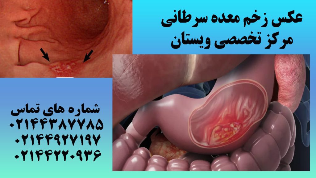 دو تصویر از ایجاد زخم سرطانی در معده