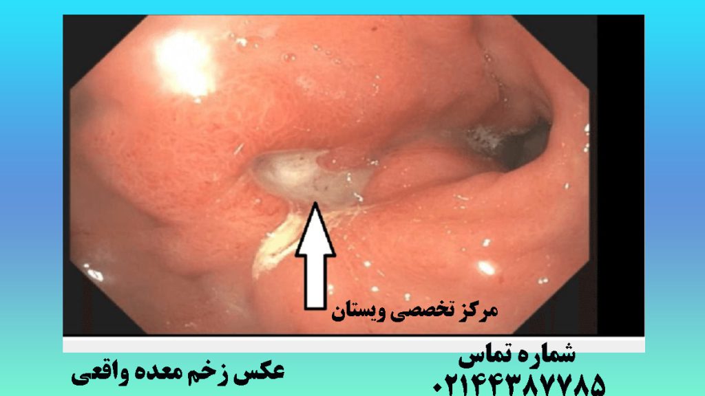 زخم معده بصورت مشخص در تصویر آندوسکوپی دیده می شود