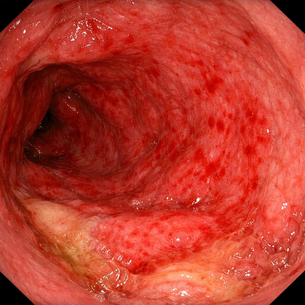 عکس ورم معده در آندوسکوپی