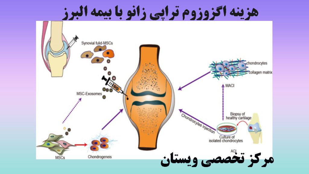 مراحل اگزوزوم تراپی زانو 