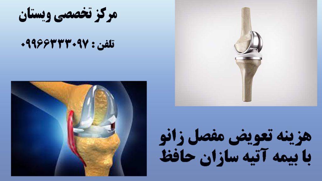 دو تصویر غیر واقعی از تعویض مفصل زانو - نوشته : هزینه تعویض مفصل زانو