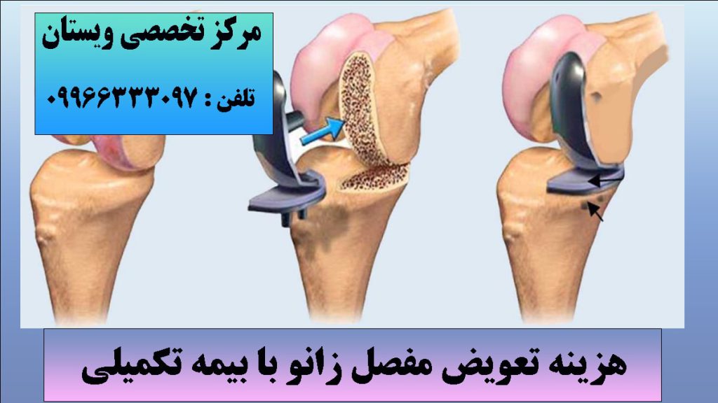 مراحل انجام تعیض مفصل زانو بصورت انیمیشنی