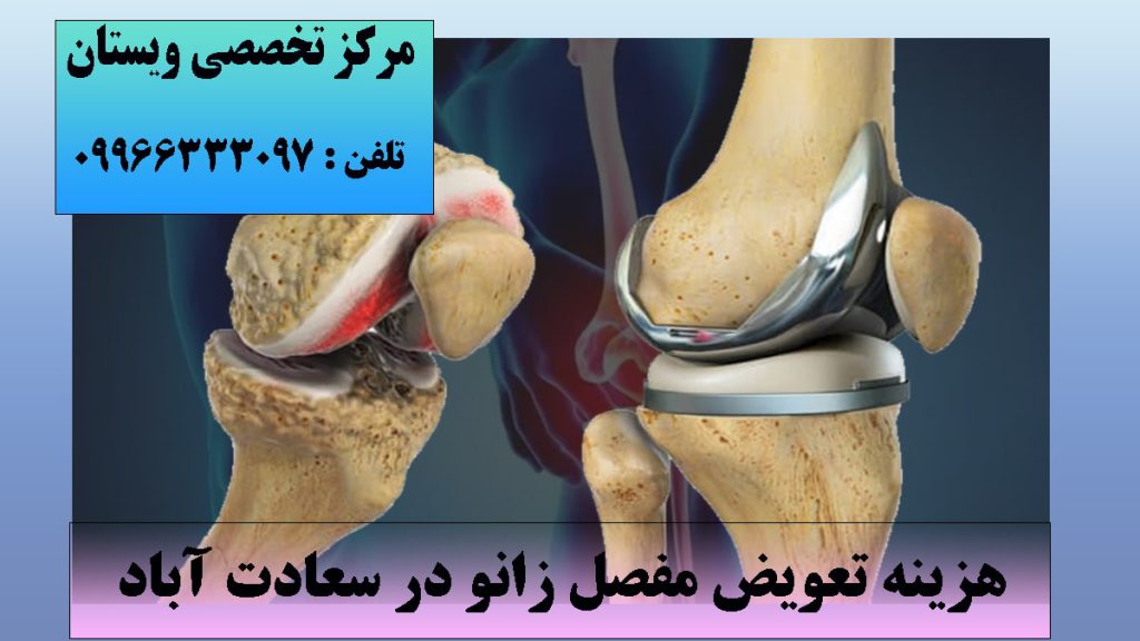 تصویر انیمیشنی از یک مفصل زانو آسیب دیده و یک مفصل زانوی جایگزین شده