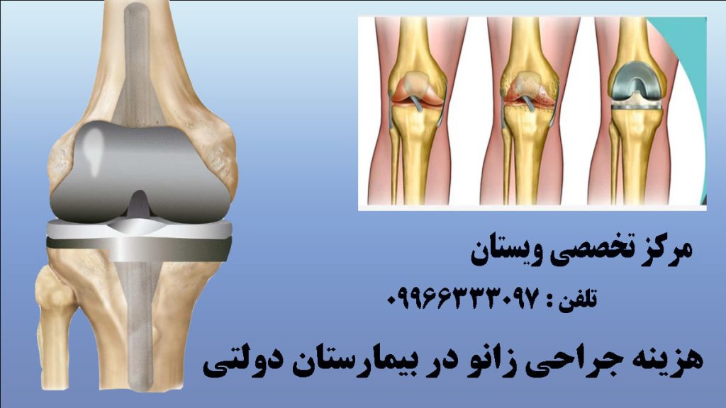 دو تصویر از مراحل انجام تعویض مفصل زانو و یک مفصل زانو بعد از عمل