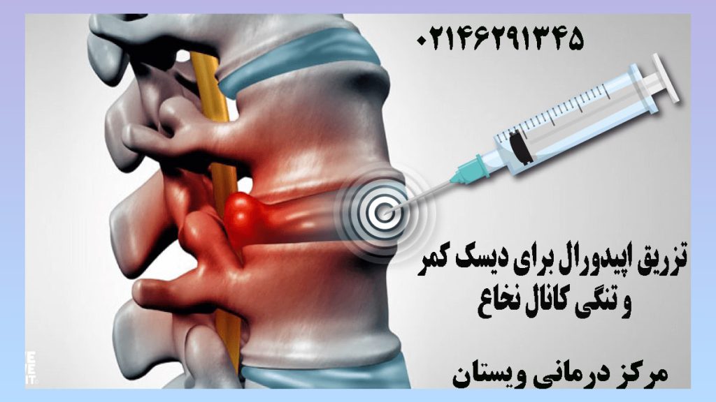 تزریق آمپول به مهره های ستون فقرات