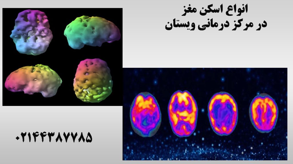 دو تصویر از اسکن مغز و اسکن هسته ای مغز
