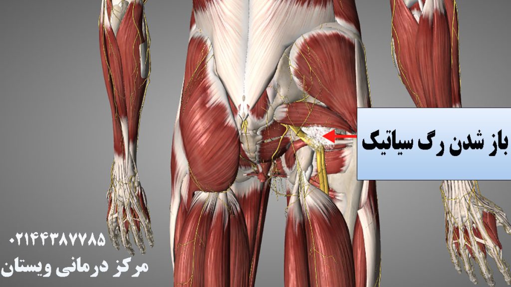 رگ سیاتیک پای شخص با رنگ زرد نشان داده شده است-نوشته :باز شدن رگ سیاتیک