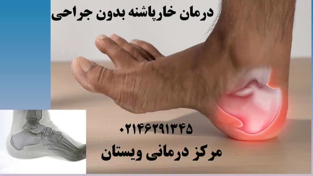 یک پاشنه با علامت هشدار درد برای نشان دادن خارپاشنه