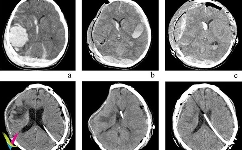 عکس سی تی اسکن مغز ناسالم