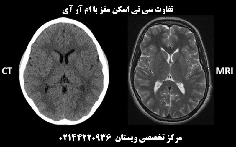 تفاوت سی تی اسکن مغز با ام آر آی مغز چیست؟