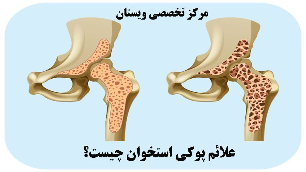 دو استخوان برای نشان دادن علائم پوکی استخوان
