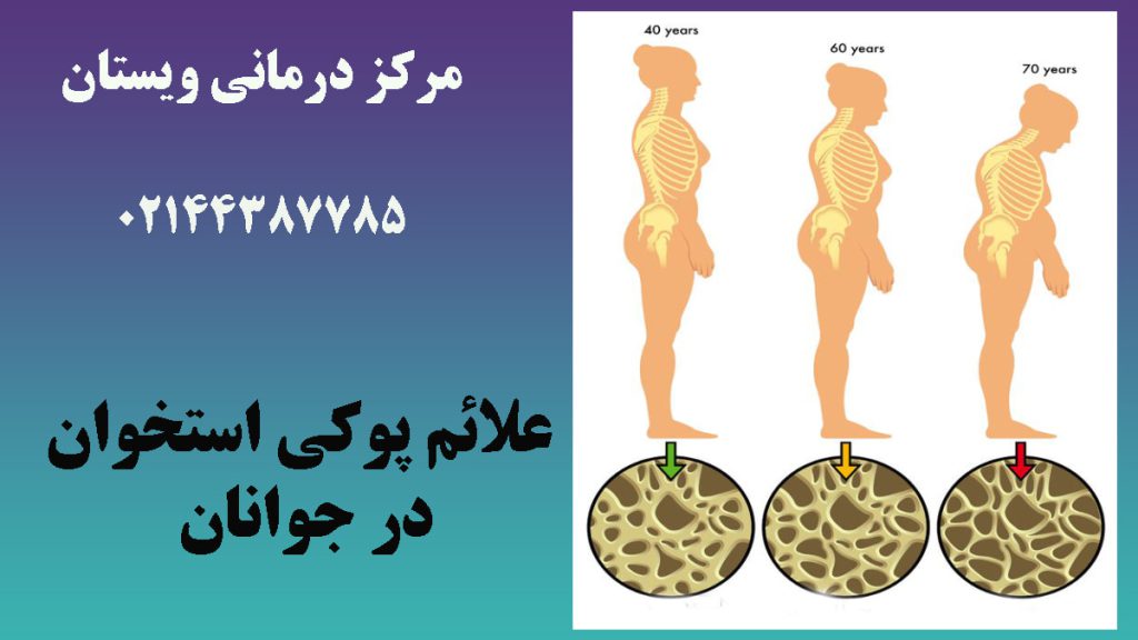 مراحل پوکی استخوان در یک شخص با نشان دادن ستون فقرات او نشان داده است