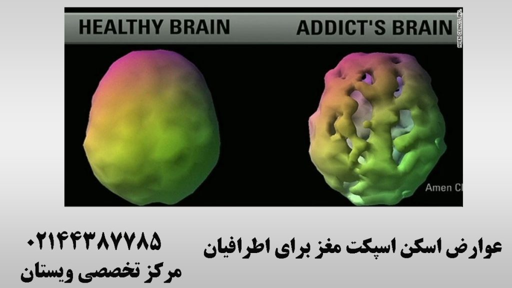 دو تصویر از اسکن هسته ای مغز سالم و بیمار