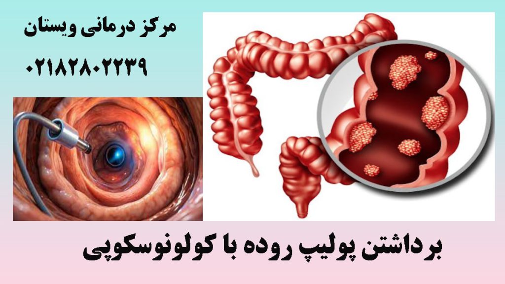 دو تصویر از روده و پولیپ آن - نوشته : برداشتن پولیپ روده با کولونوسکوپی