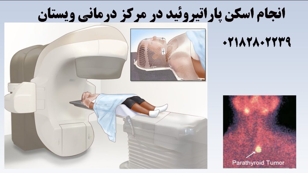 تصویر انیمیشنی از اسکن پاراتیروئید و نتیجه آن