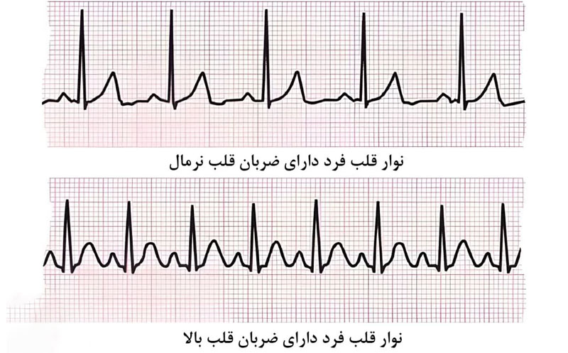 نوار قلب فرد دارای ضربان قلب بالا