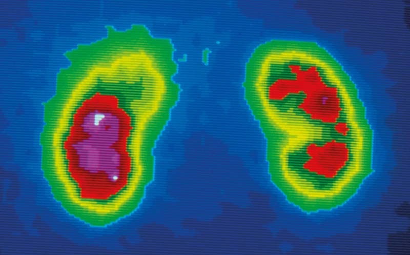 عوارض اسکن کلیه