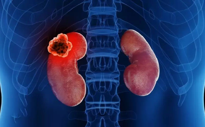 تفسیر جواب اسکن کلیه ناسالم