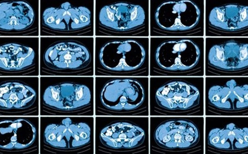 انواع اسکن هسته ای کلیه