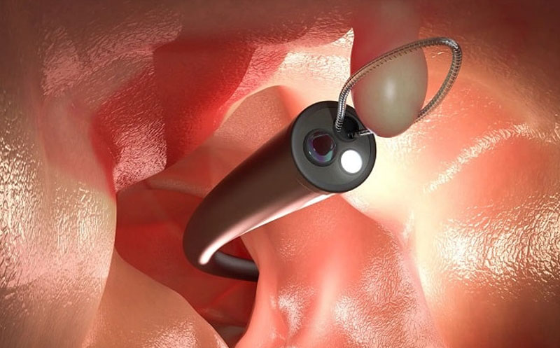 مراقبت‌های بعد از کولونوسکوپی زنان