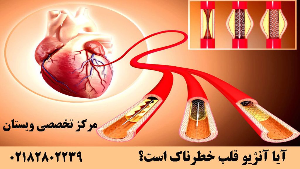تصویر نمادین از آنژیو قلب-نوشته: آیا آنژیو قلب خطرناک است؟
