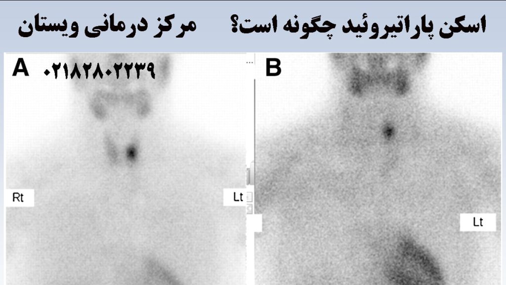 تصویر از نتیجه اسکن پاراتیروئید