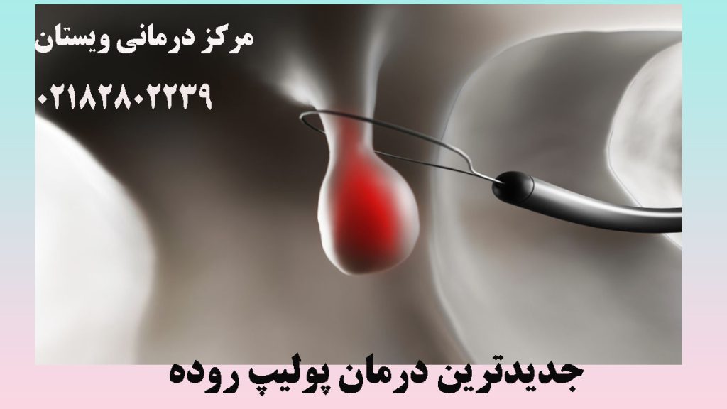 دستگاه کولونوسکوپی در حال برداشتن پولیپ روده