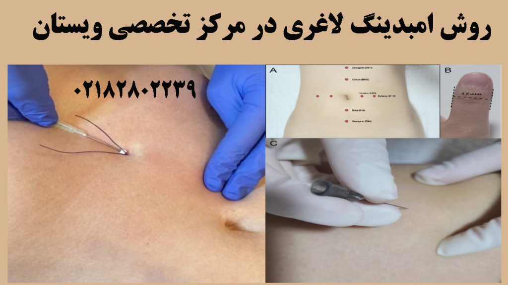 دو تصویر از کاشت نخ در شکم 