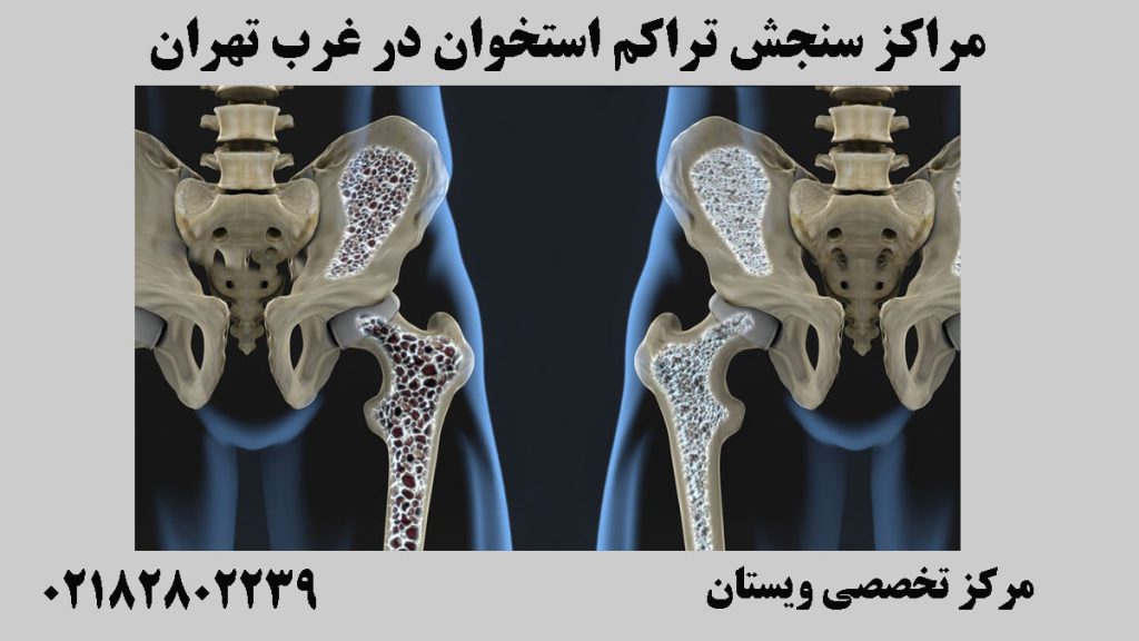 تصویر دیجیتالی از سنجش تراکم استخوان لگن-نوشته : مراکز سنجش تراکم استخوان در غرب تهران 