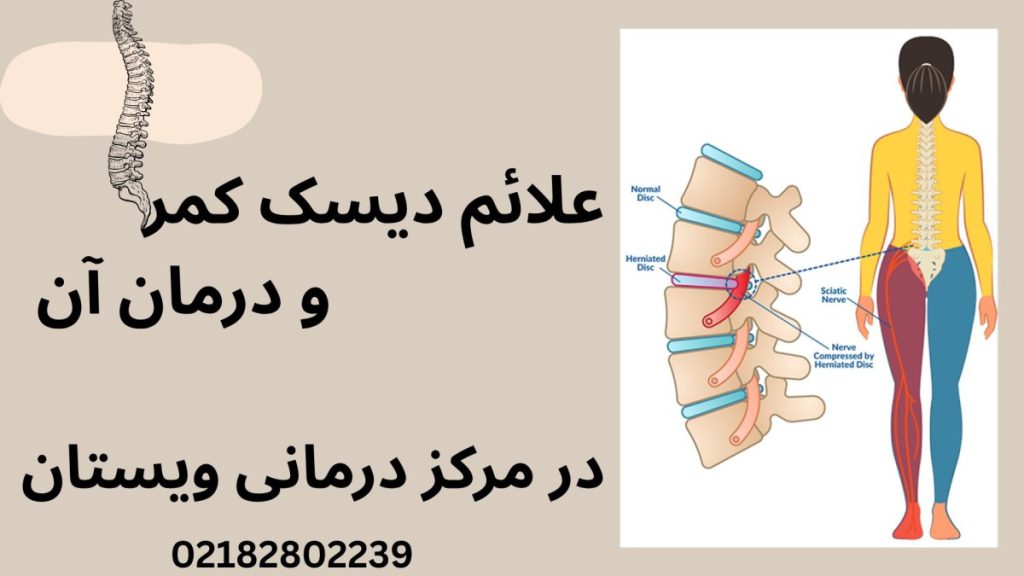 درمان دیسک کمر در ویستان