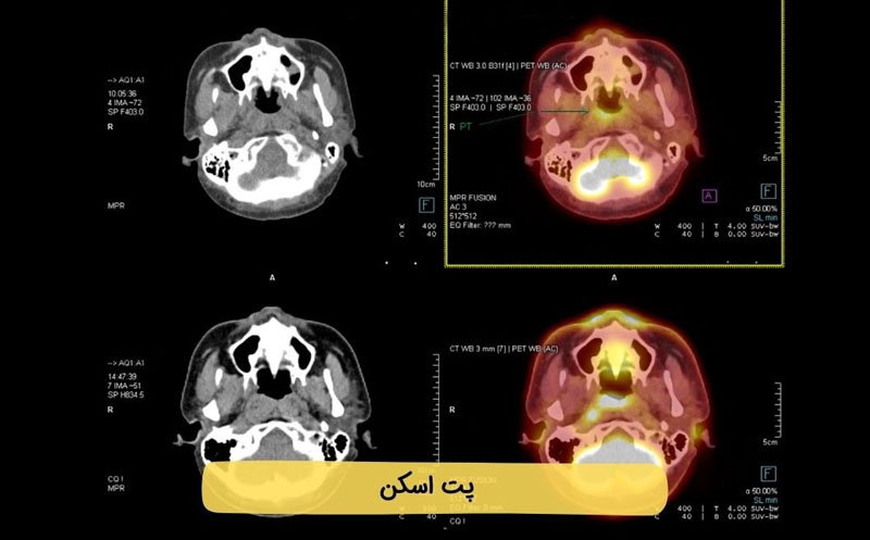 SUVmax در پت اسکن چیست؟