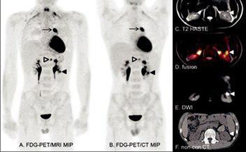 پت اسکن بعد از شیمی درمانی