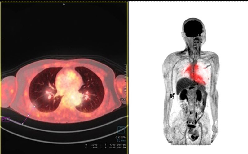 عکس پت اسکن سرطانی