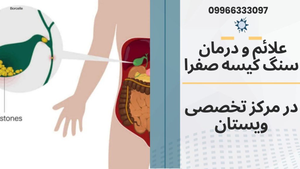 درمان سنگ صفرا در ویستان