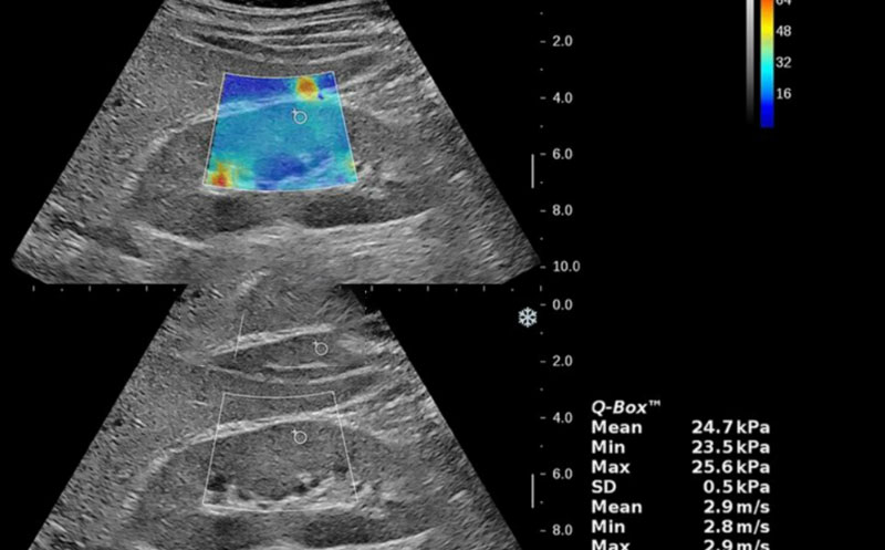 نحوه خواندن جواب فیبرو اسکن کبد