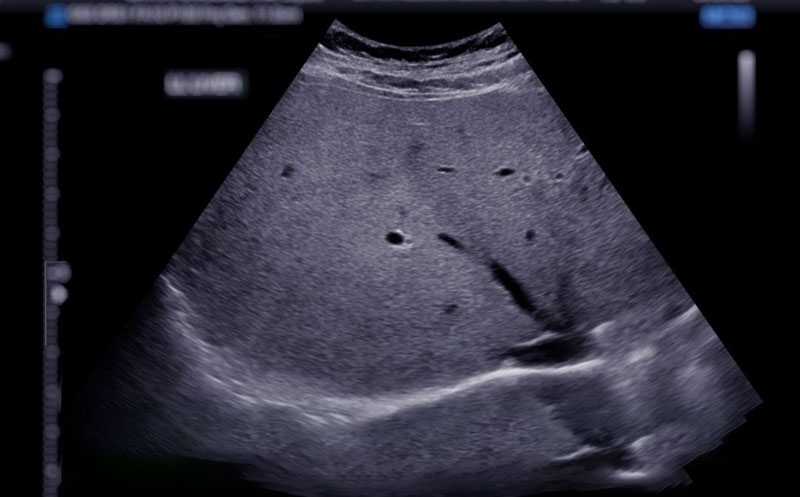 S3 در جواب فیبرو اسکن کبد