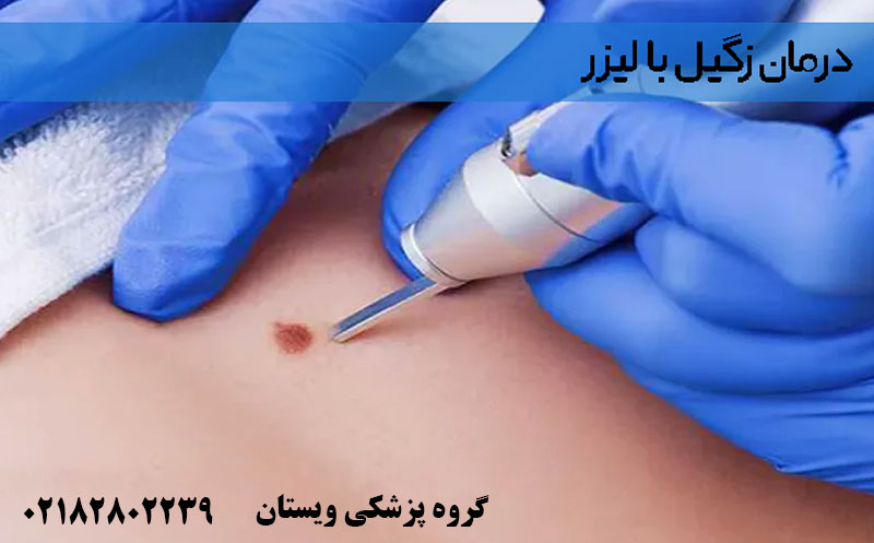 هزینه لیزر زگیل تناسلی | بررسی تعرفه‌ها در سال 1404