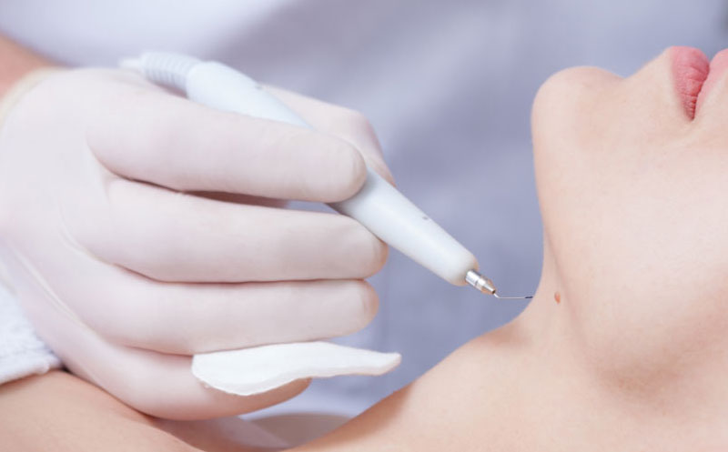 هزینه لیزر زگیل تناسلی