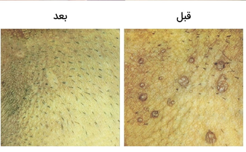 انتخاب بهترین روش درمانی برای زگیل تناسلی