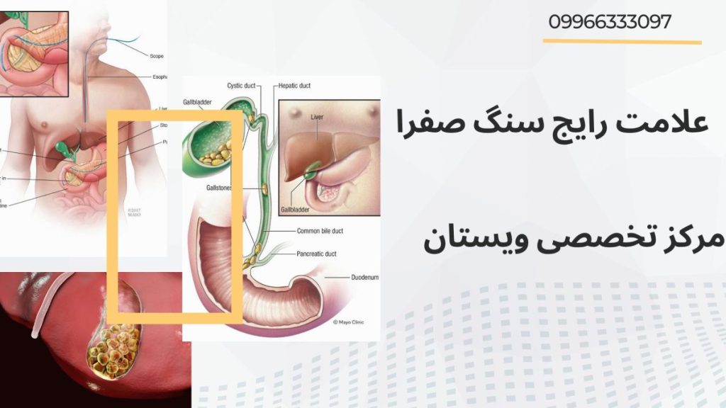 سه تصویر از سنگ صفرا در انسان