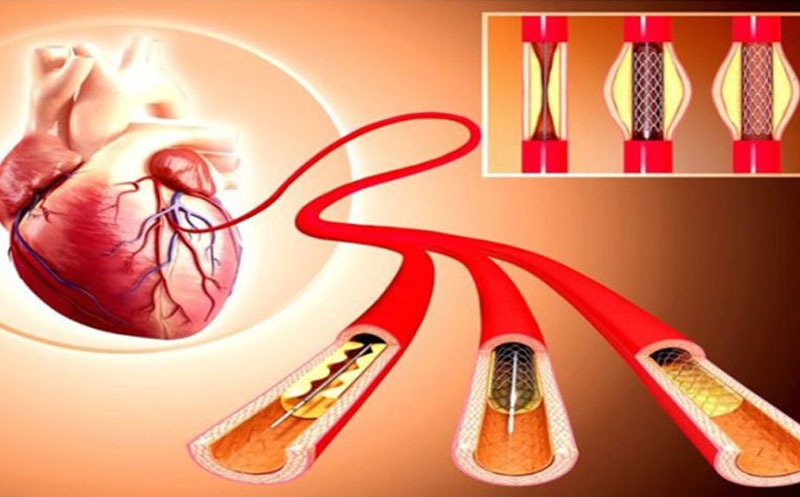 عکس رنگی قلب (پرفیوژن اسکن قلب) چیست؟