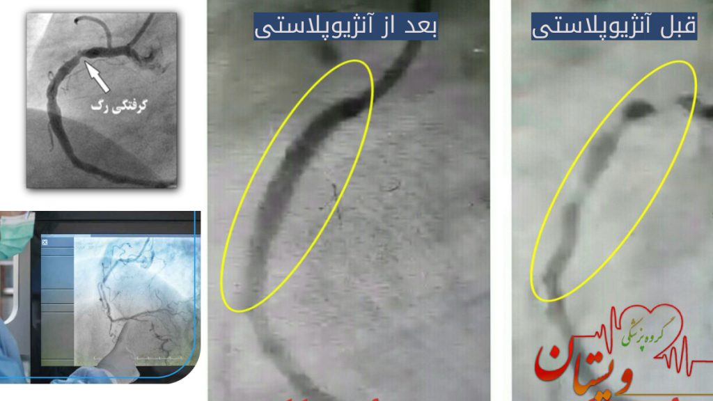 تصویری از گرفتگی رگ و عکس واقعی از قبل و بعد آنژیوپلاستی قلب 